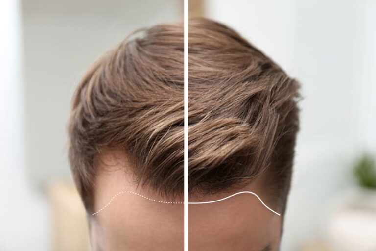 Resultado visual de tratamiento anticaída capilar SYS con mejora del aspecto del cabello en la zona frontal.
